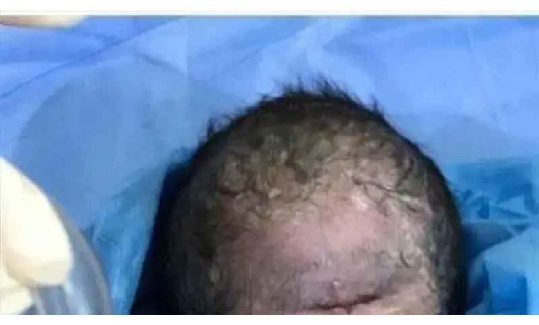 عراق میں ایک آنکھ والے بچے کی پیدائش‘ نومولود کچھ دیر بعد ہی دم توڑ گیا