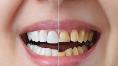 پیلے دانتوں کو جلد صاف کرنے کا طریقہ۔ دانت موتیوں کی طرح چمکنے لگیں گے