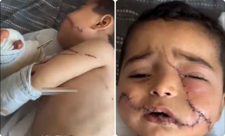 اسرائیلی بمباری میں اپنا خاندان کھودینے والا ننھا بچہ شدید زخمی، چہرے پر 200 ٹانکے (دردناک ویڈیووائرل)
