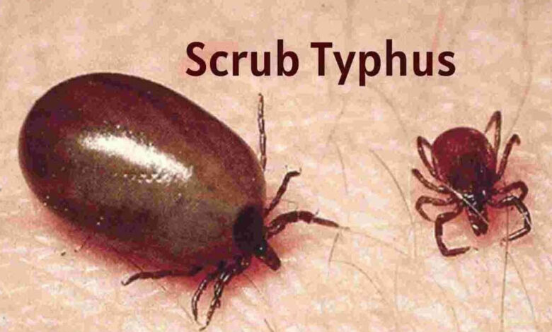 اے پی: اسکرب ٹائفس سے مرنے والوں کی تعداد 20 ہوگئی