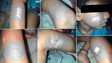 Heartbreaking incident in Hyderabad: Tuition teacher burns seven-year-old child with hot spoon in OU Colony