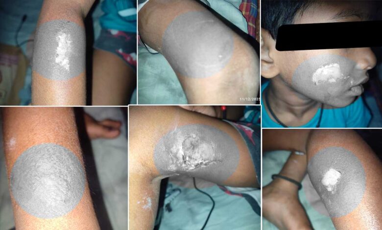 Heartbreaking incident in Hyderabad: Tuition teacher burns seven-year-old child with hot spoon in OU Colony