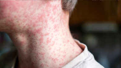 امریکہ میں 2025 میں خسرہ کے 2,000 سے زیادہ کیسز درج ہوئے