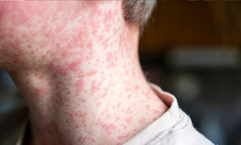 امریکہ میں 2025 میں خسرہ کے 2,000 سے زیادہ کیسز درج ہوئے