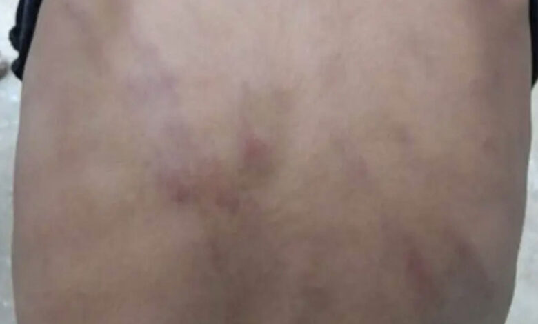 تلنگانہ میں دوسری جماعت کے طالب علم پر استاد کا مبینہ تشدد
