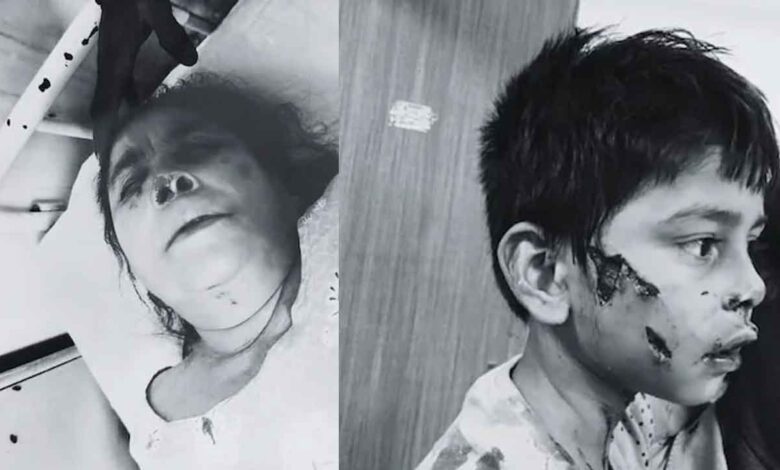 بھوپال میں آوارہ کتے کا قہر، 8 سالہ بچے کو 10 میٹر تک گھسیٹا، چہرے پر15 ٹانکے